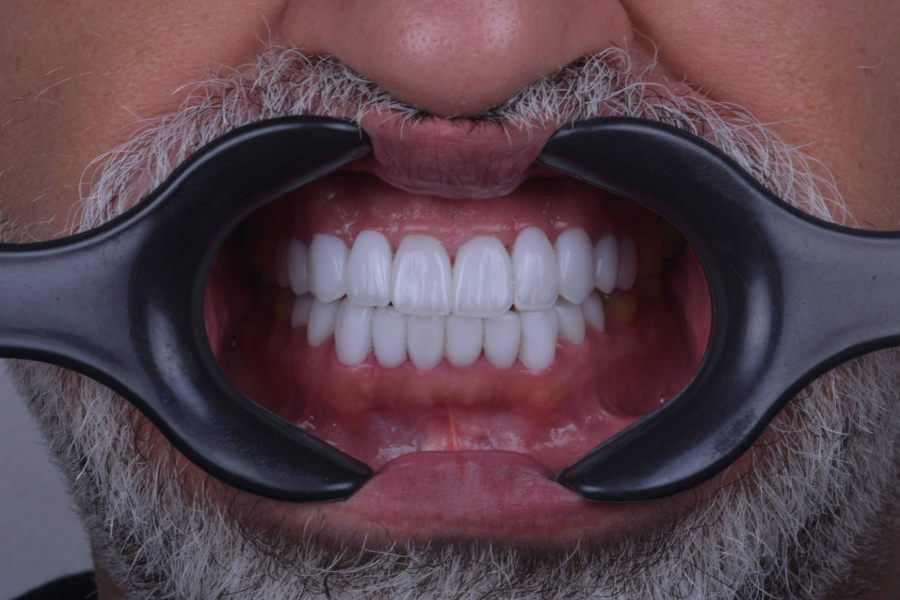 بعد تغير لون و شكل الأسنان لإعادة تأهيل الابتسامة.